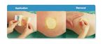 Aposito-Hidrocoloide-Semi-Permeavel-ALGOPLAQUE-HP