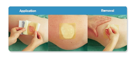 Aposito-Hidrocoloide-Semi-Permeavel-Fino-ALGOPLAQUE-FILM