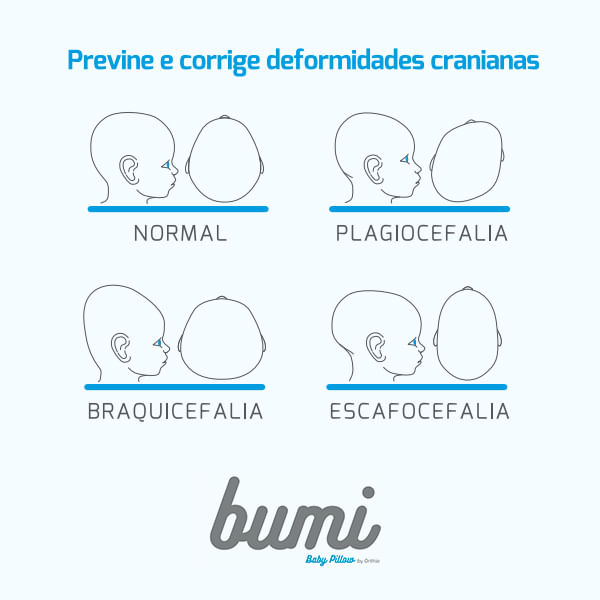 Almofada-Deformidades-Cranianas